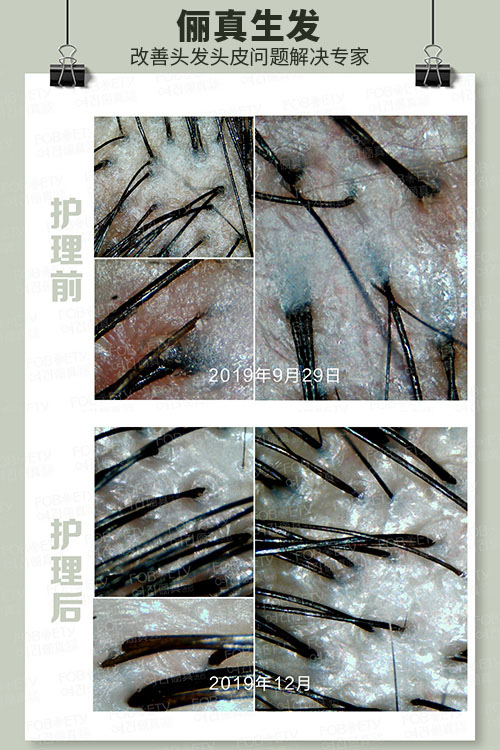 頭油、頭癢