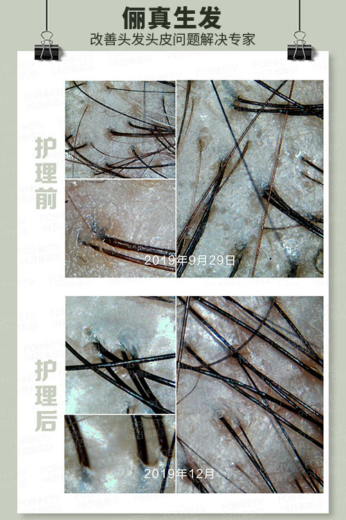 頭油、頭癢