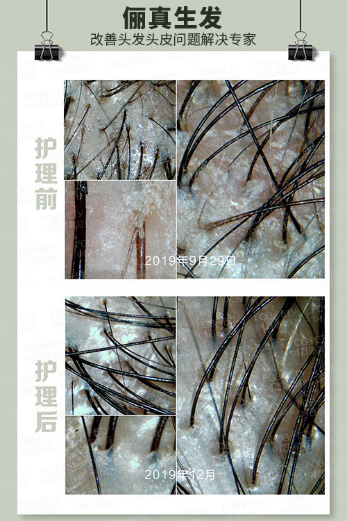 頭油、頭癢